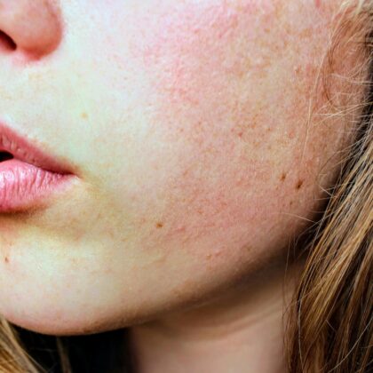 Detailed close-up of a woman's facial skin showing natural texture and complexion.